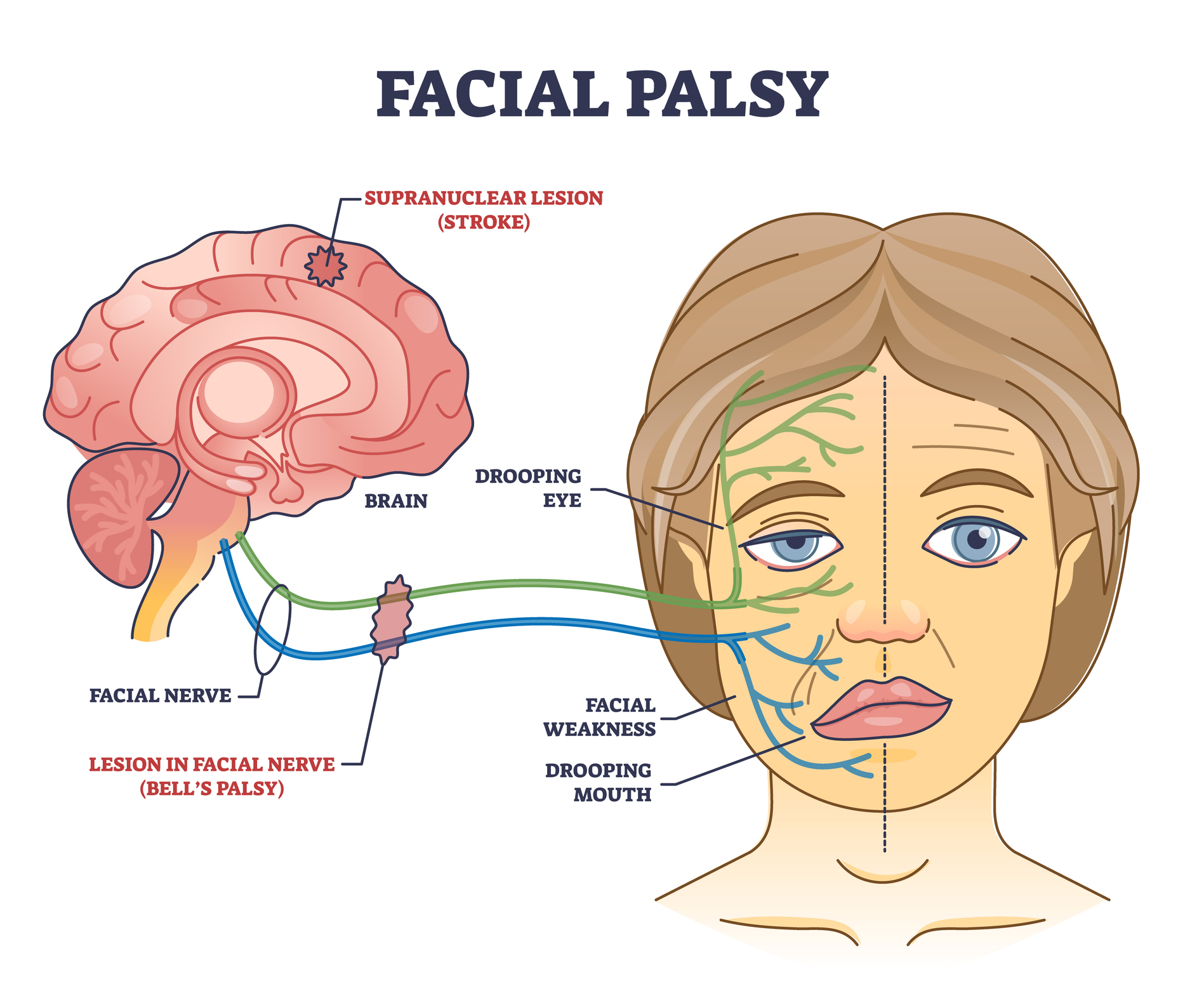 Raising Awareness for Facial Nerve Disorders: How You Can Help